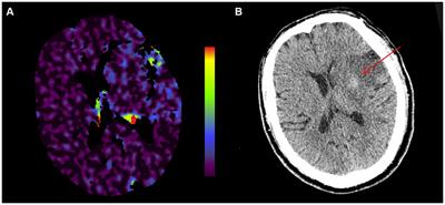 Blood-brain barrier disruption and hemorrhagic transformation in acute stroke before endovascular reperfusion therapy